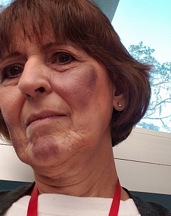 Photos from the Disaster  drill at LSSC;  can we say ecchymosis ?